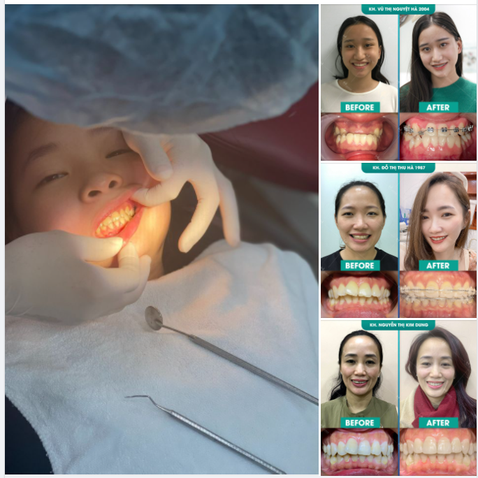 ĐỘ TUỔI NÀO THÍCH HỢP ĐỂ NIỀNG RĂNG?