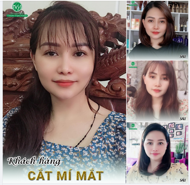 ĐÔI MẮT ĐẸP RẠNG NGỜI SAU 4 NĂM