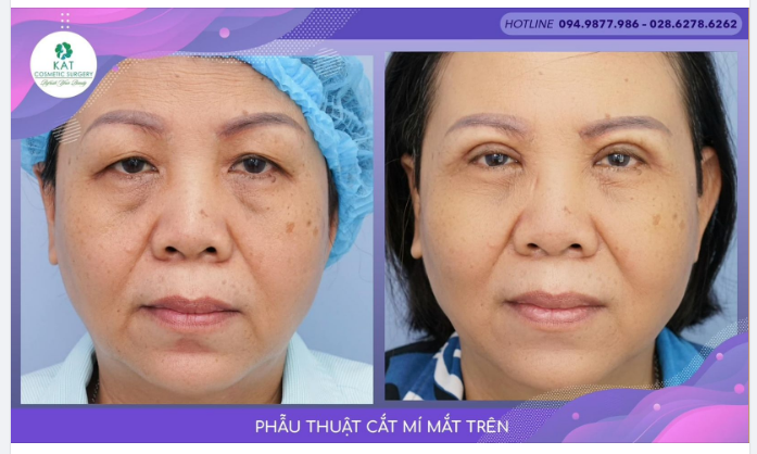 “Đôi mắt nặng trĩu do thoái hóa, đuôi mắt sụp phải làm sao, phải làm sao “