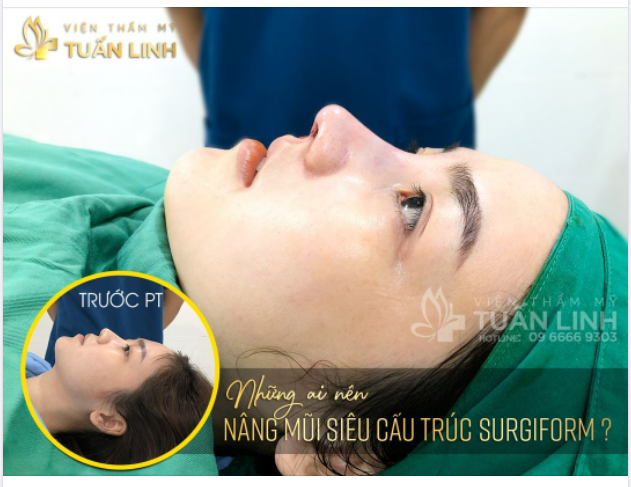 Đối tương nào nêm nâng mũi siêu cấu trúc Surgiform