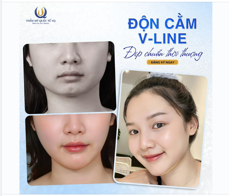 Độn cằm Vline - Đẹp chuẩn thời thượng