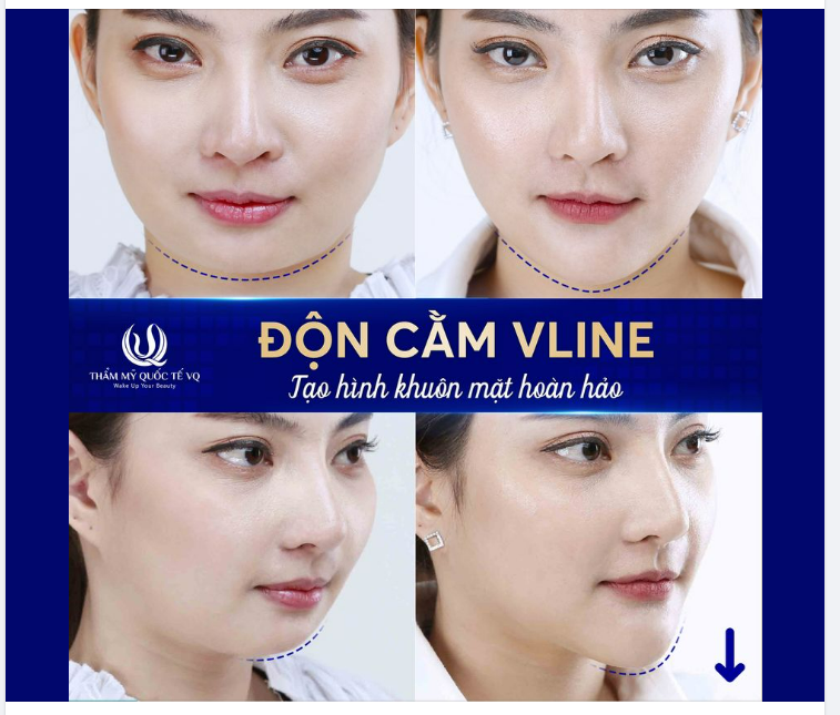 ĐỘN CẰM VLINE - Giải quyết triệt để cằm ngắn, cằm lẹm, cằm bành, cằm lệch