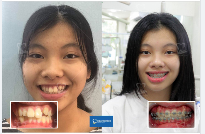 Đồng niềng đi trước là đồng niềng khôn