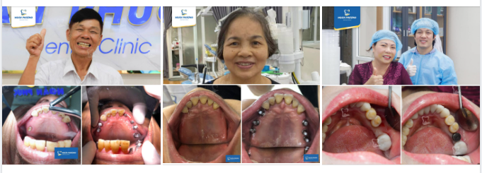 ĐỪNG ĐỂ NHỮNG LỖ HỔNG DO MẤT RĂNG GÂY KHÓ CHỊU, CẢN TRỞ BỮA ĂN VÀ GÂY HẠI CHO SỨC KHOẺ CỦA CHA MẸ NỮA