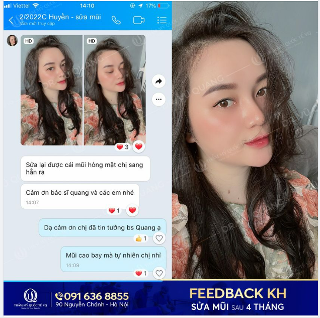 FEEDBACK 4 THÁNG TẠO NÊN SỰ KHÁC BIỆT nhờ Sửa mũi cấu trúc Softline tại VQ