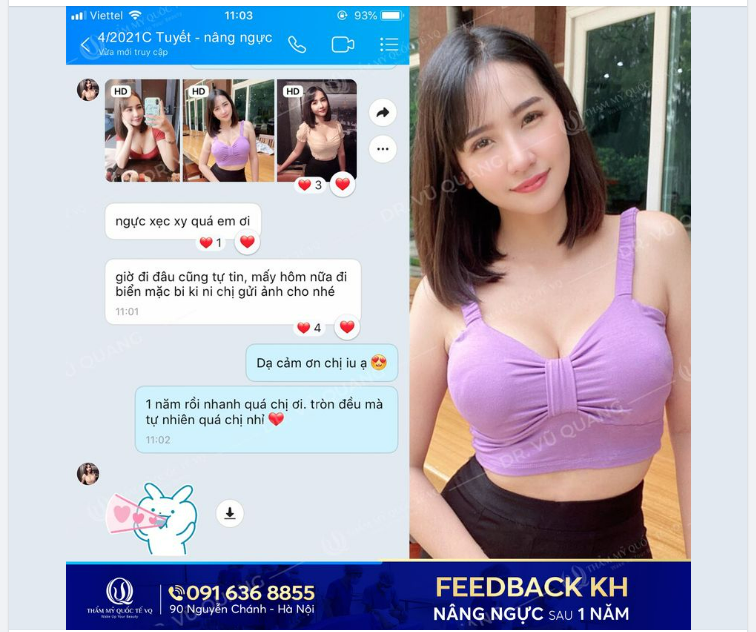 Feedback khách hàng sau 1 năm Nâng vòng 1 nội soi Công nghệ cao của Dr Vũ Quang