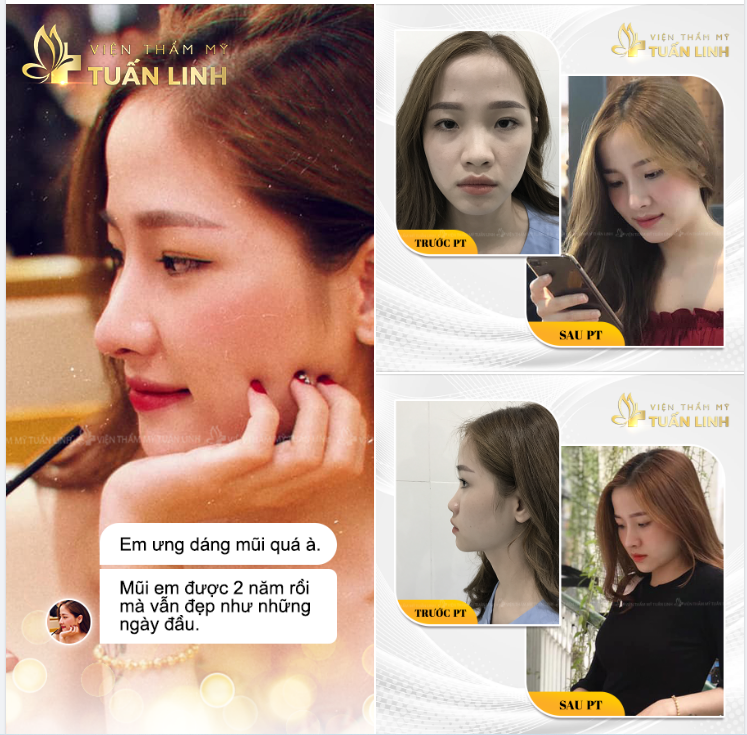 Feedback khách hàng. Diện mạo rạng rỡ với dáng mũi cao xinh