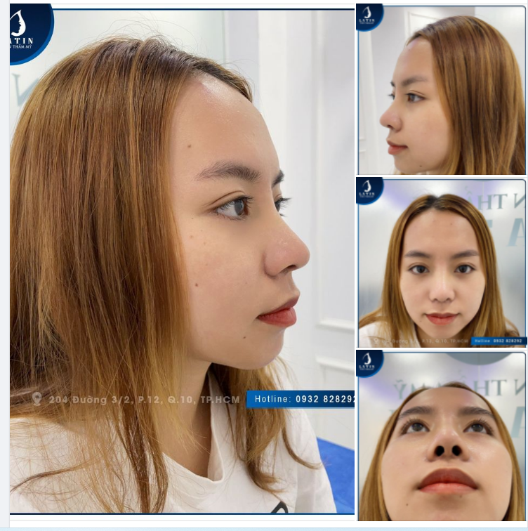 Feedback mũi bán cấu trúc sau 2 tuần của khách hàng lần đầu tiên nâng mũi