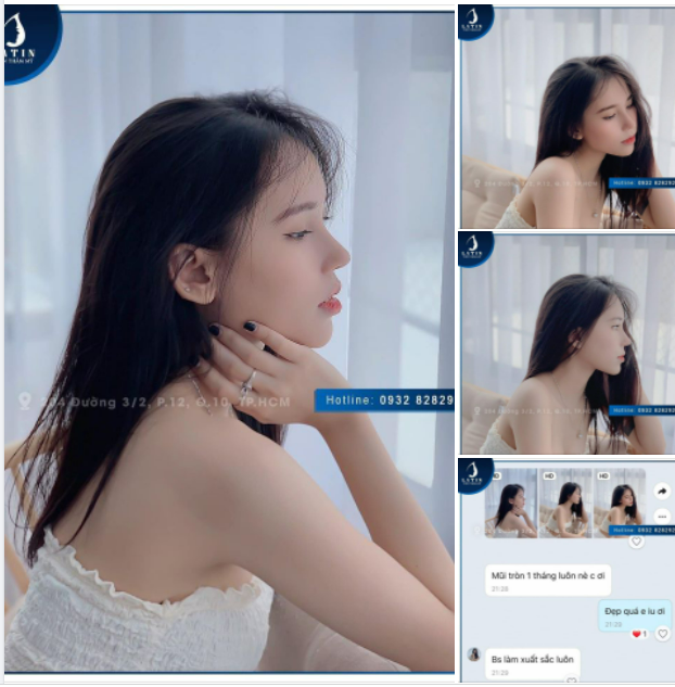 FEEDBACK Mũi cấu trúc sau 1 tháng