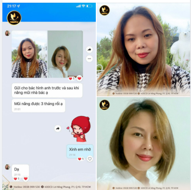 FEEDBACK MŨI CẤU TRÚC SỤN SƯỜN 3 THÁNG