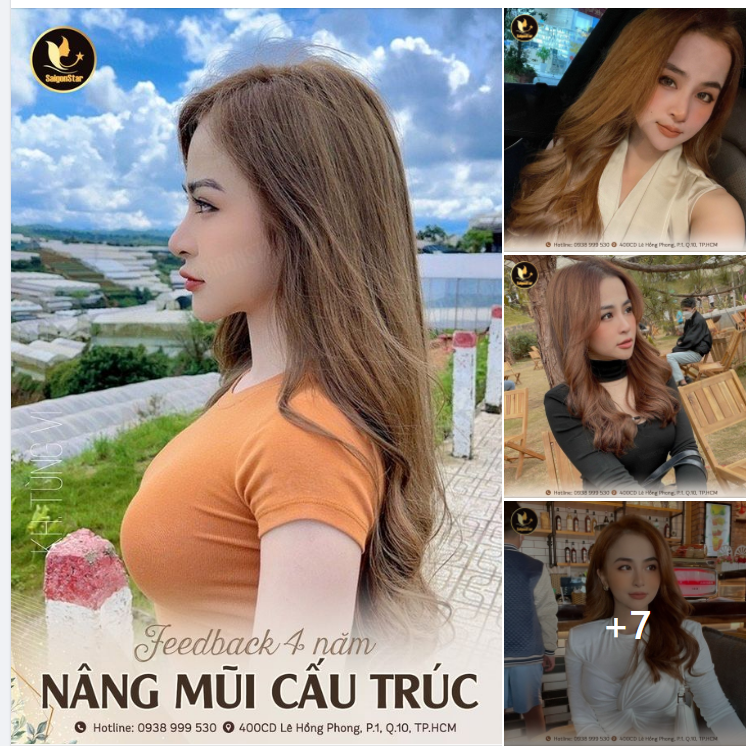 FEEDBACK NÂNG MŨI 4 NĂM TỪ HOT GIRL ĐÀ LẠT – TÙNG VI