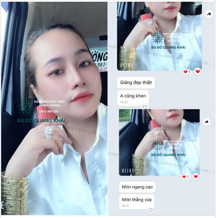 Feedback Nâng mũi cấu trúc của Hotgirl nhà Đỗ Quang Khải