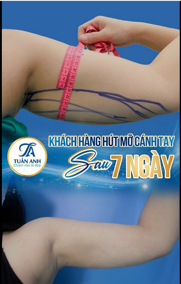 Feedback sau 7 ngày hút mỡ cánh tay của chị khách tại Thẩm Mỹ Tuấn Anh đây ạ!