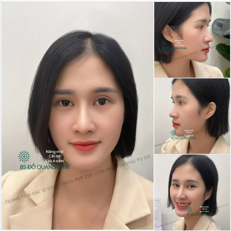 Gặp lại khách hàng sau 4 năm nâng mũi cắt mí.