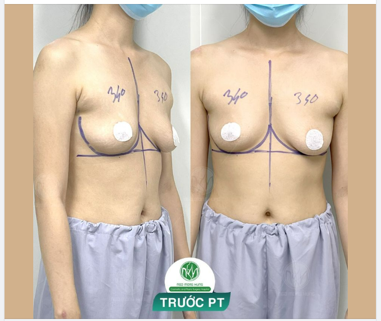 GIẢI CỨU BẦU NGỰC NHỎ - SA TRỄ NHẸ