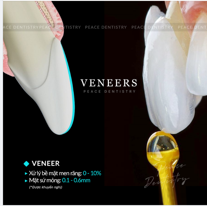 GIẢI ĐÁP NHỮNG CÂU HỎI PHỔ BIẾN VỀ MẶT DÁN SỨ VENEER: