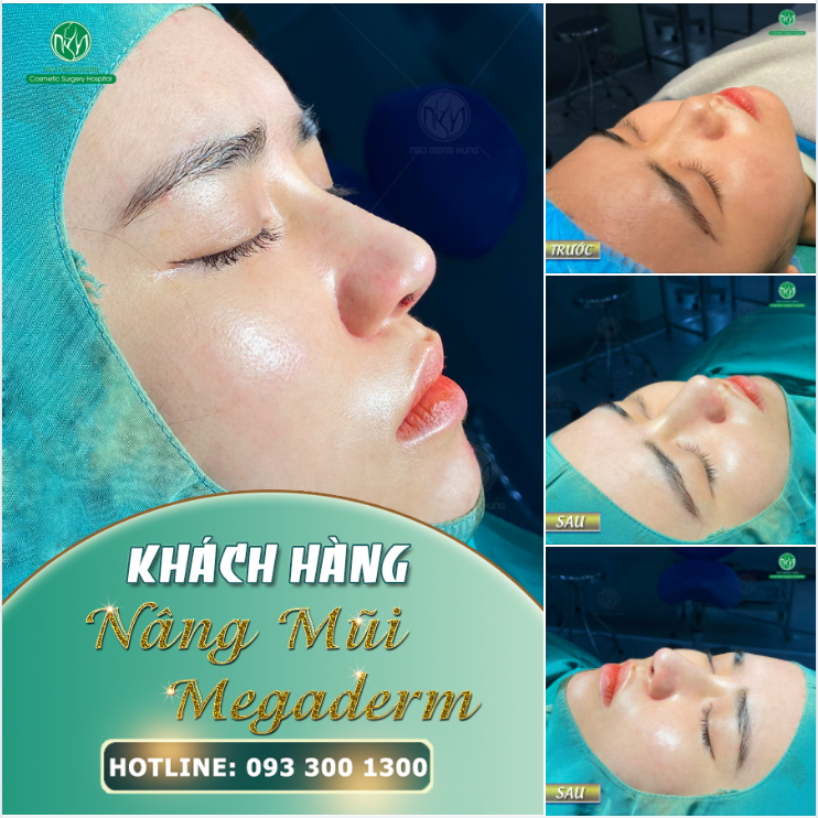 GIẢI PHÁP AN TOÀN HIỆU QUẢ CHO NHỮNG DÁNG MŨI THẤP