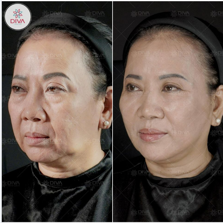 GIẢM CHẢY XỆ, TRẺ HÓA TOÀN DIỆN SAU TIÊM 17CC FILLER MD CODES CHO DIỄN VIÊN PHƯƠNG NGỌC
