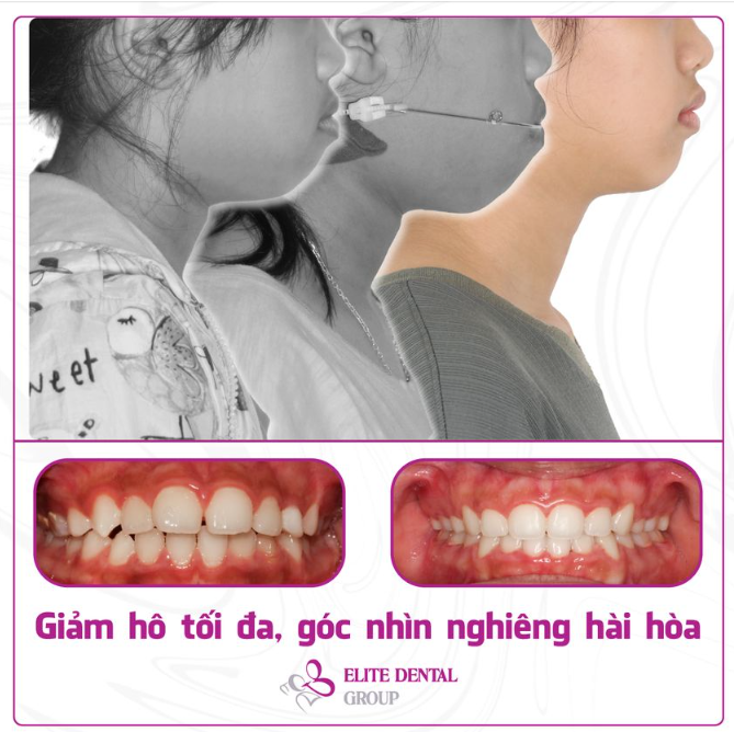 GIẢM HÔ TỐI ĐA CHO BÉ GÁI TRONG GIAI ĐOẠN THAY RĂNG