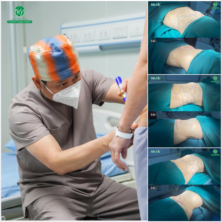 GIẢM MỠ VỚI COMBO HÚT MỠ KẾT HỢP CĂNG DA BỤNG