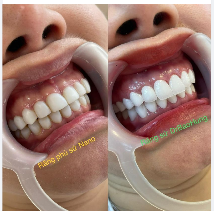 Giờ không biết còn ai lầm tưởng giữa phủ sứ Nano và làm răng sứ thẩm mỹ nữa không nhị