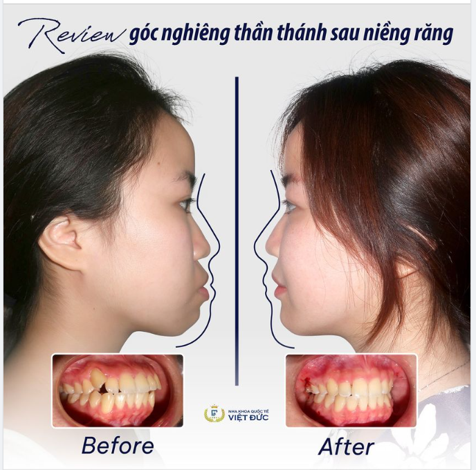GÓC NGHIÊNG CỦA BẠN SẼ THAY ĐỔI THẾ NÀO SAU KHI NIỀNG RĂNG