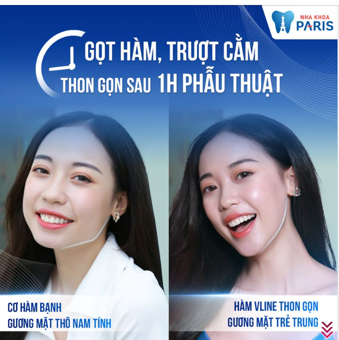 Gọt hàm Vline hoá nàng thơ xinh đẹp