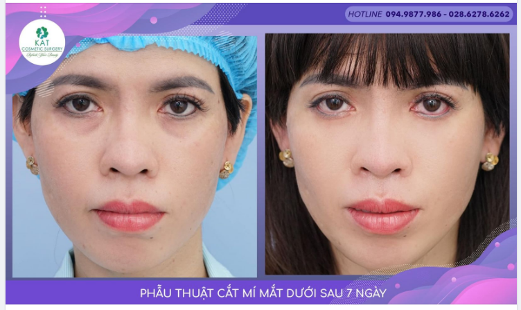 “Gương mặt luôn nặng trĩu âu lo vì bọng mắt dưới!”