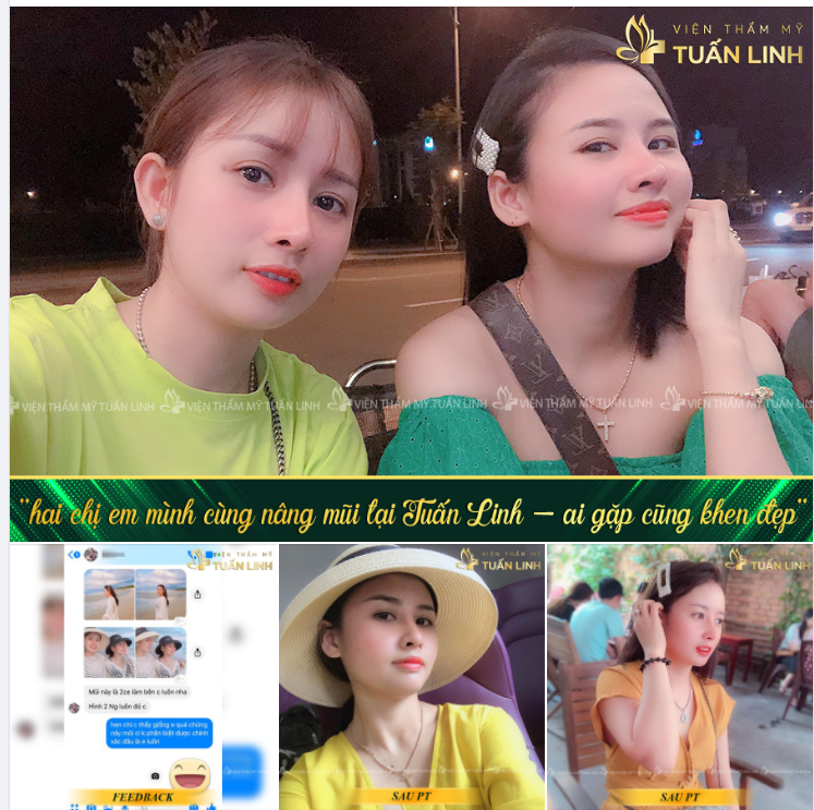 '' Hai chị em mình cùng nâng mũi tại Tuấn Linh - Mũi cao tự nhiên, ai nhìn cũng khen xinh hết''