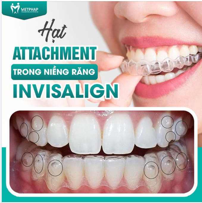 HẠT ATTACHMENT TRONG NIỀNG RĂNG INVISALIGN