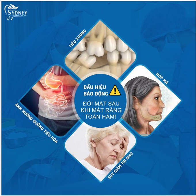 HẬU QUẢ MẤT RĂNG TOÀN HÀM RẤT NGUY HIỂM