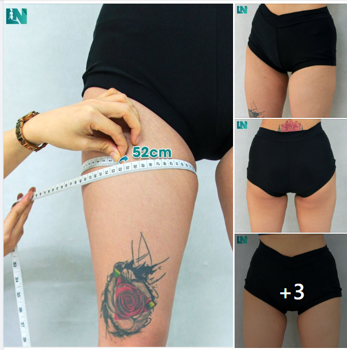 HIỆN THỰC MONG ƯỚC SỞ HỮU ĐÔI CHÂN THON NUỘT VỚI  HÚT MỠ ĐÙI CHO CHỊ KH 9X