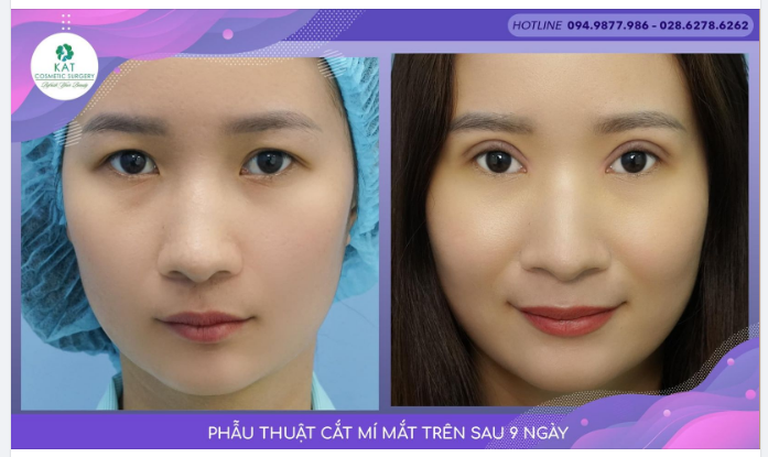 Hình ảnh khách hàng cắt mí