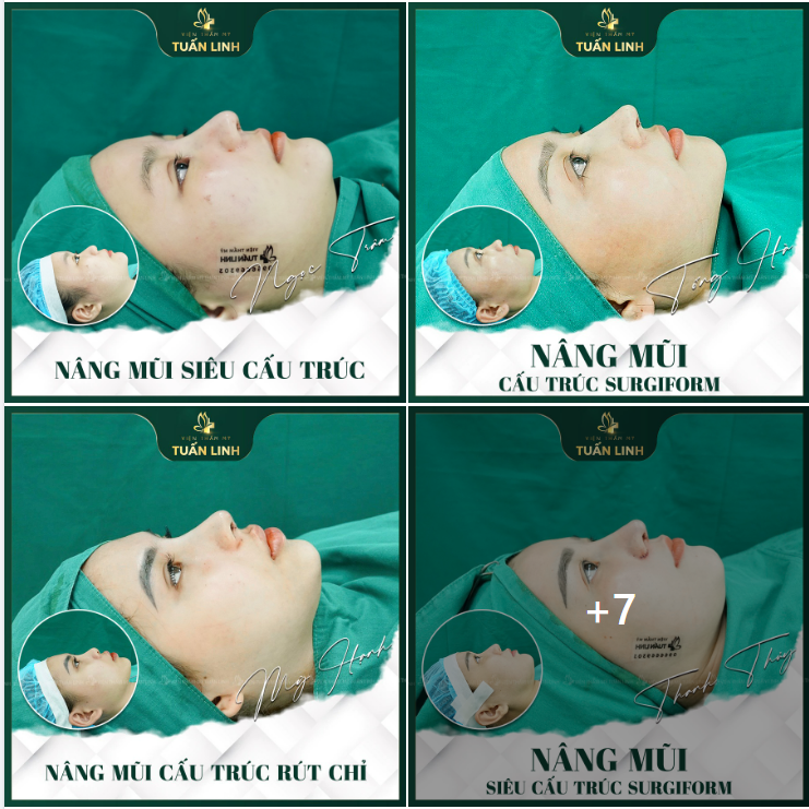 HÌNH ẢNH KHÁCH HÀNG VỪA HOÀN THIỆN DÁNG MŨI SAU PHẪU THUẬT TẠI TUẤN LINH