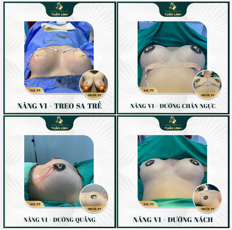 Hình ảnh nâng V1 được thực hiện tại bệnh viện
