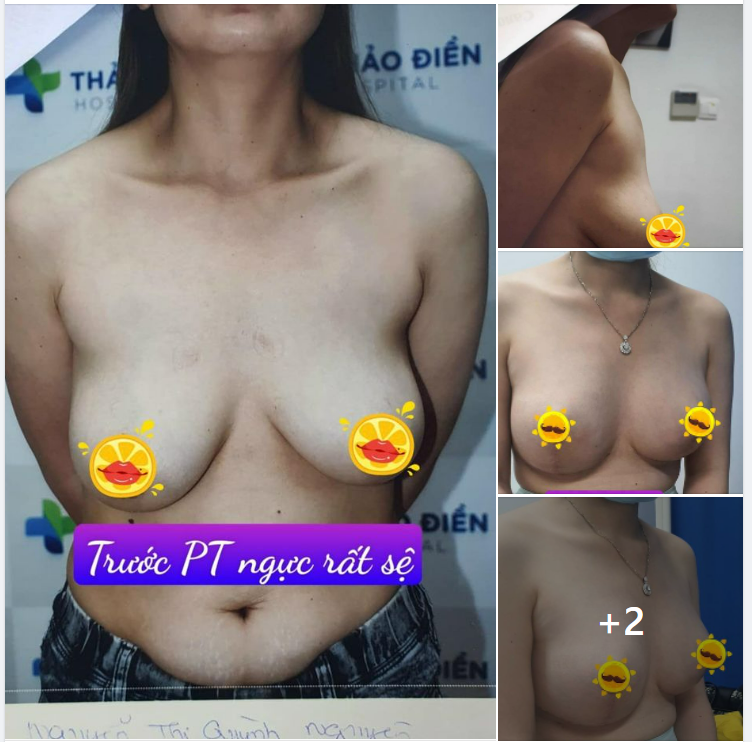 ​​​​​​​Hình ảnh thực tế dưới đây nói lên tất cả, ngực rất sệ,2 bên không đều,to nhỏ khác nhau.
