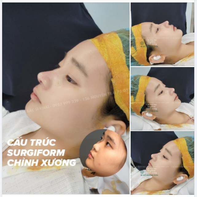 HOÀN THÀNH CA NÂNG MŨI ĐẶT SÓNG SURGIFORM + CHỈNH XƯƠNG