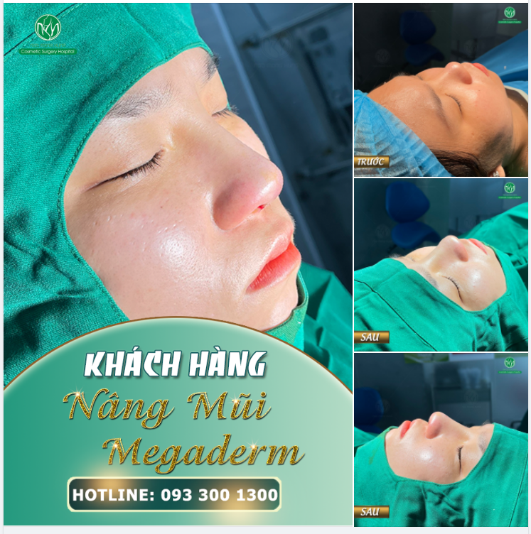 HOÀN THÀNH CA NÂNG MŨI MEGADERM