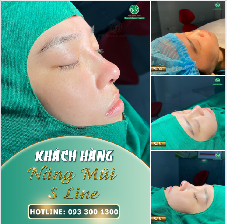 HOÀN THÀNH CA NÂNG MŨI VÀI PHÚT TRƯỚC