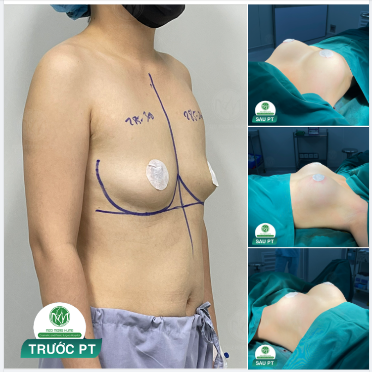 HOÀN THÀNH VÀI PHÚT TRƯỚC CA NÂNG NGỰC CHO KH