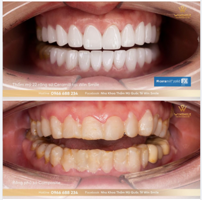 HỐI HẬN VÌ QUYẾT ĐỊNH VỘI VÀNG, NHỜ WIN SMILE “CỨU NGUY” CHO HÀM RĂNG