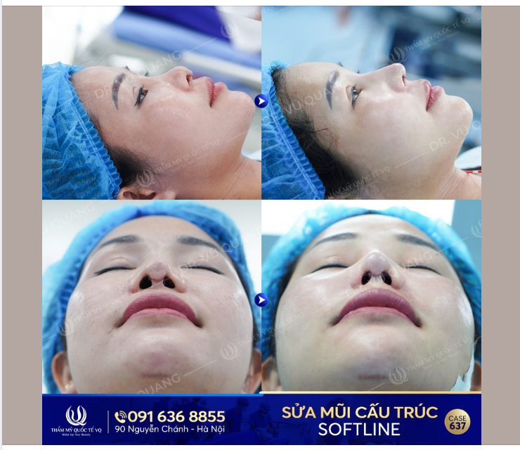 HỒI SINH Mũi hỏng cho K.H Việt Kiều Đài Loan sau 2 lần Thẩm mỹ tại nước ngoài.