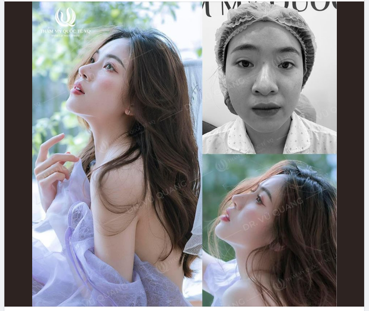 HOT TIKTOKER Bé Gấu được Dr Vũ Quang sửa lại mũi hỏng
