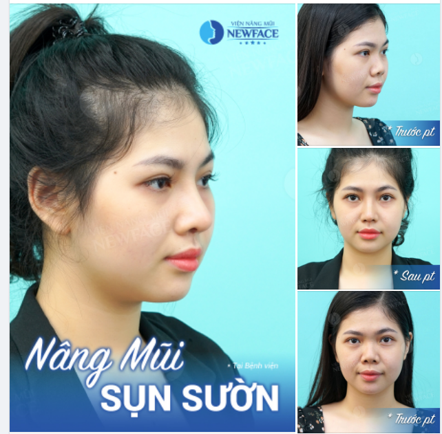 HOTGIRL ẢNH THẺ Đẹp Ngất Ngây Nhờ Nâng Mũi Sụn Sườn