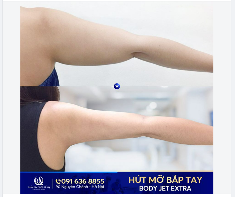 HÚT MỠ BẮP TAY - BAY NGAY MỠ THỪA