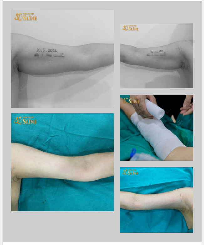 HÚT MỠ CÁNH TAY - ĐẸP NGAY TỨC THÌ