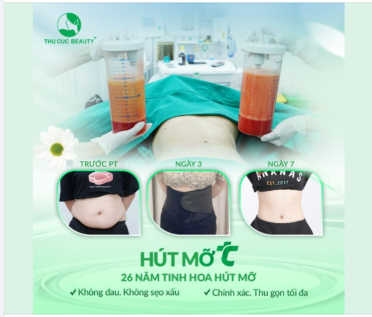 Hút mỡ chỉ ~60 phút ​​​​​​​ Đẹp ngay sau 7 ngày
