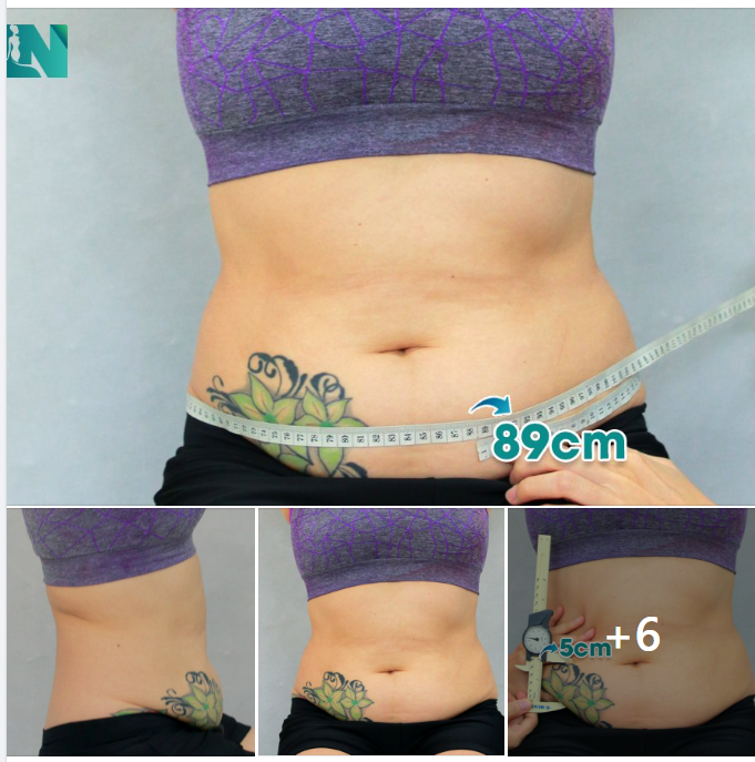 HÚT MỠ TẠO DÁNG THẨM MỸ - GIẢI PHÁP SỞ HỮU VÒNG EO THẮT NHỎ KHÔNG CAN THIỆP CĂNG DA, KHÔNG ĐỂ LẠI SẸO CHO CHỊ KH 40 TUỔI SAU SINH.