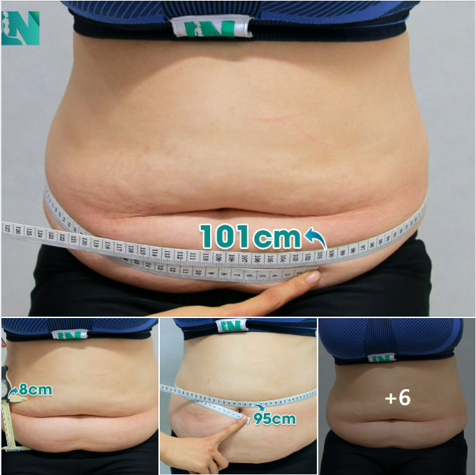 HÚT MỠ TẠO DÁNG THẨM MỸ VÒNG BỤNG HƠN 1 MÉT CHO CHỊ KH 35 TUỔI KHÔNG CAN THIỆP CĂNG DA NHƯNG BỤNG THON NHỎ, DA PHẲNG PHIU ÔM SÁT; TRỰC TIẾP 16H30 HÔM NAY