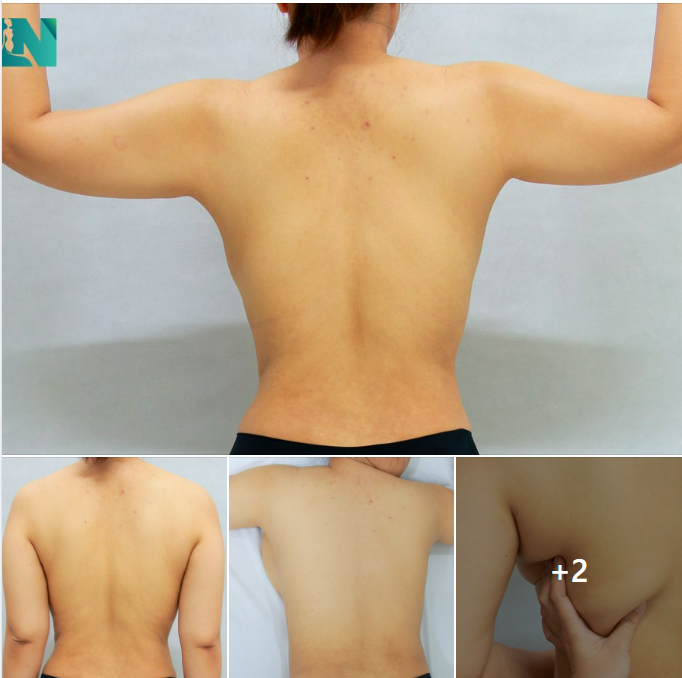 HÚT MỠ TẠO DÁNG THẨM MỸ VÙNG THÂN TRÊN TAY, LƯNG, NÁCH CHO CHỊ KH 36 TUỔI, ĐÃ HÚT MỠ BỤNG BÁC SĨ LƯƠNG NGỌC 2 THÁNG TRƯỚC. TRỰC TIẾP VÀO 15H30 -16H00 HÔM NAY